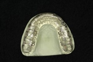 Roth splint (bite)